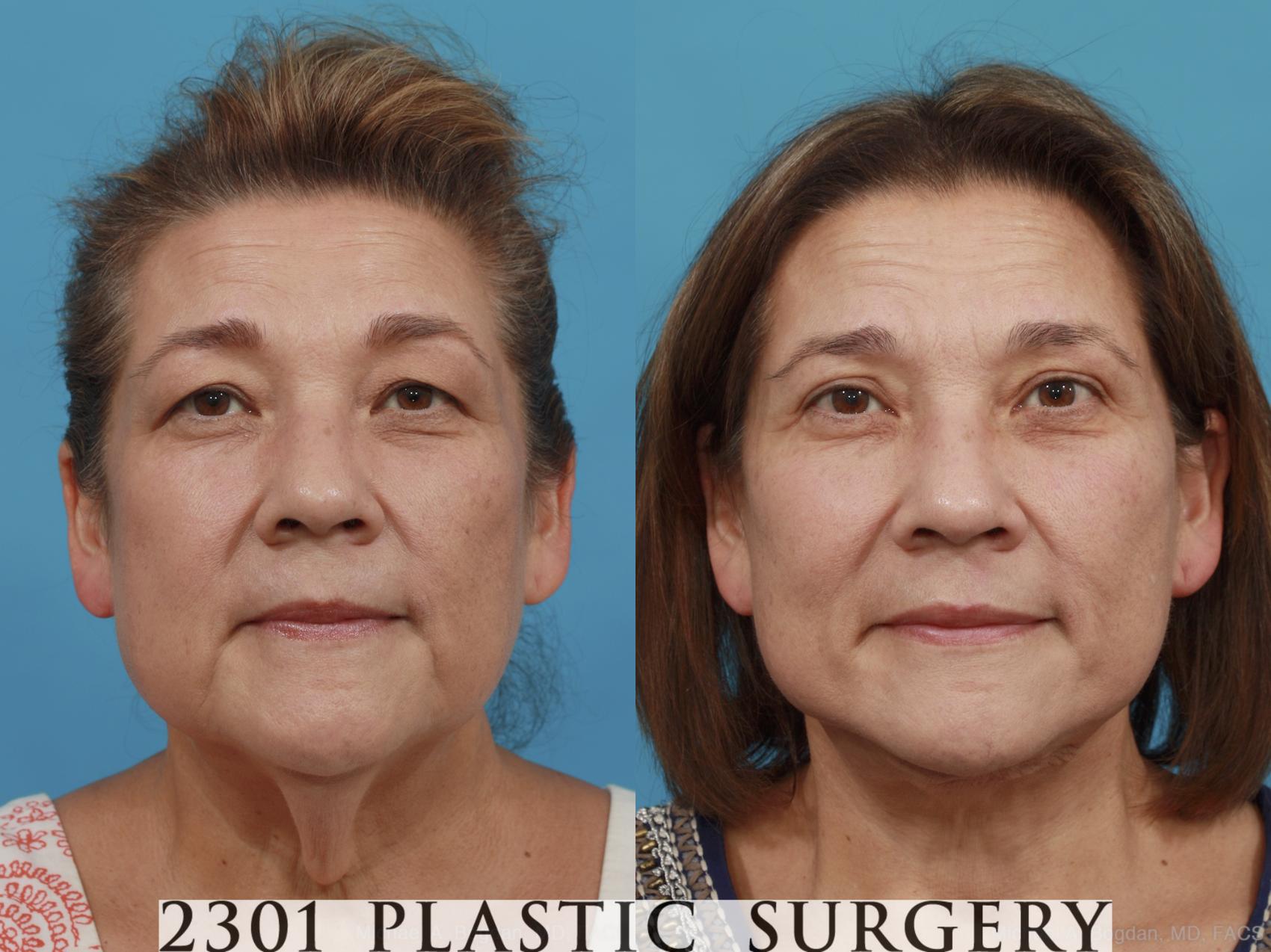 Before & After Neck Lift Case 481 View #1 View in Fort Worth, Plano, & Frisco, Texas