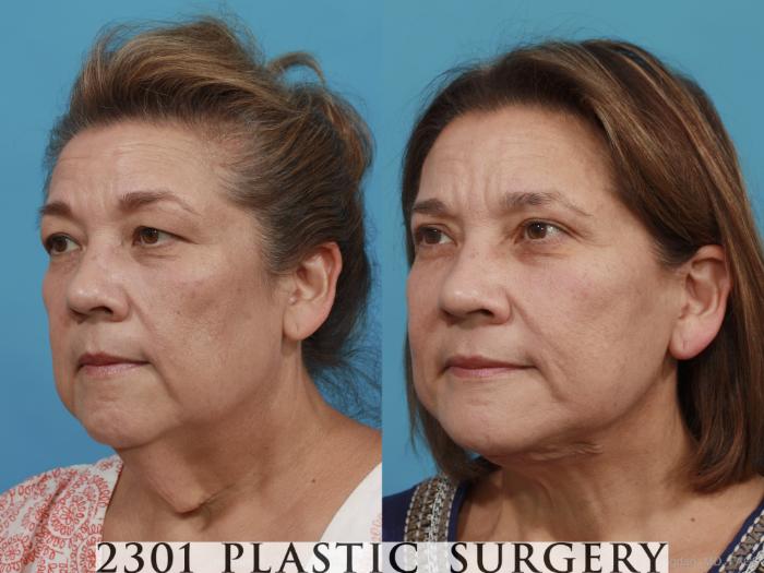 Before & After Neck Lift Case 481 View #2 View in Fort Worth, Plano, & Frisco, Texas
