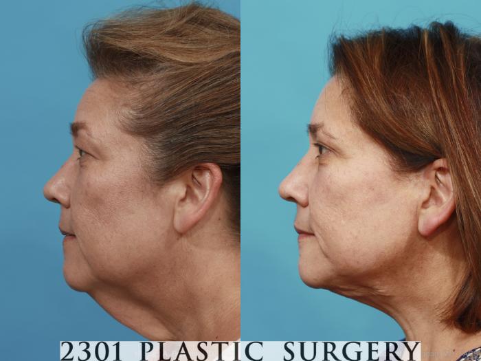Before & After Neck Lift Case 481 View #3 View in Fort Worth, Plano, & Frisco, Texas