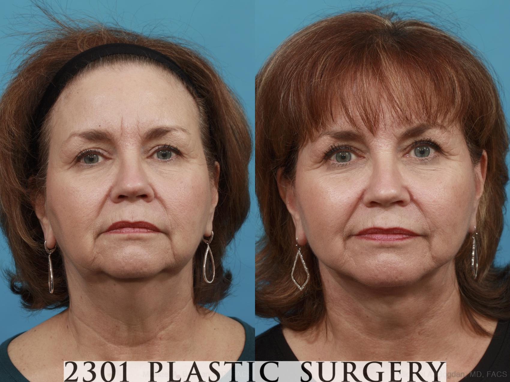 Before & After Neck Lift Case 495 View #1 View in Fort Worth, Plano, & Frisco, Texas