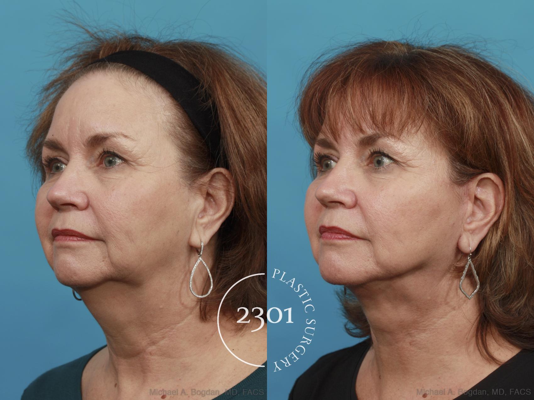Before & After Neck Lift Case 495 View #2 View in Fort Worth, Plano, & Frisco, Texas