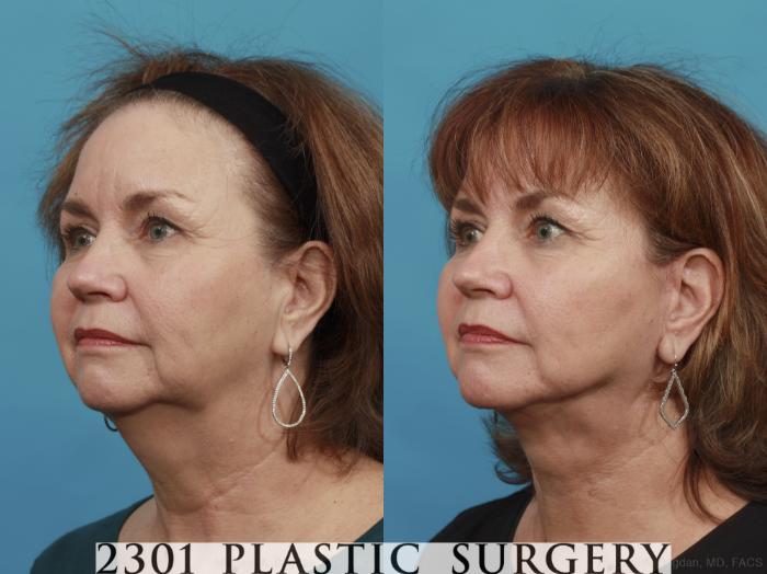 Before & After Neck Lift Case 495 View #2 View in Fort Worth, Plano, & Frisco, Texas
