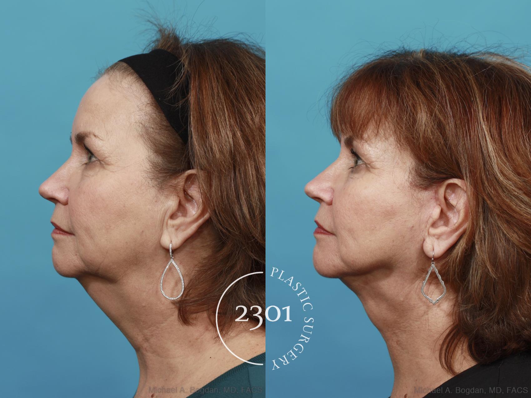 Before & After Neck Lift Case 495 View #3 View in Fort Worth, Plano, & Frisco, Texas