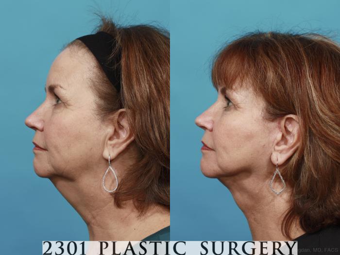 Before & After Neck Lift Case 495 View #3 View in Fort Worth, Plano, & Frisco, Texas