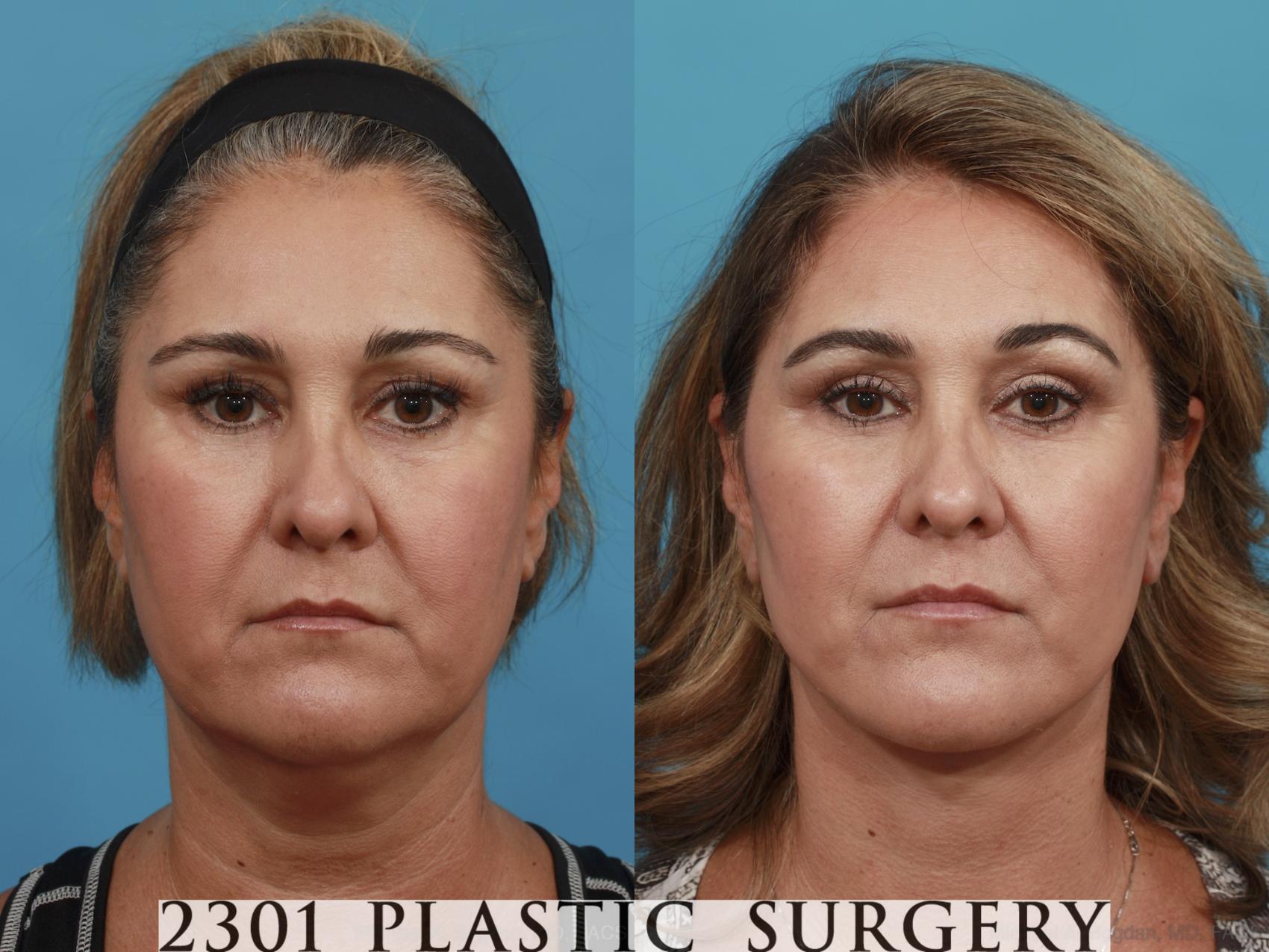 Before & After Neck Lift Case 503 View #1 View in Fort Worth, Plano, & Frisco, Texas