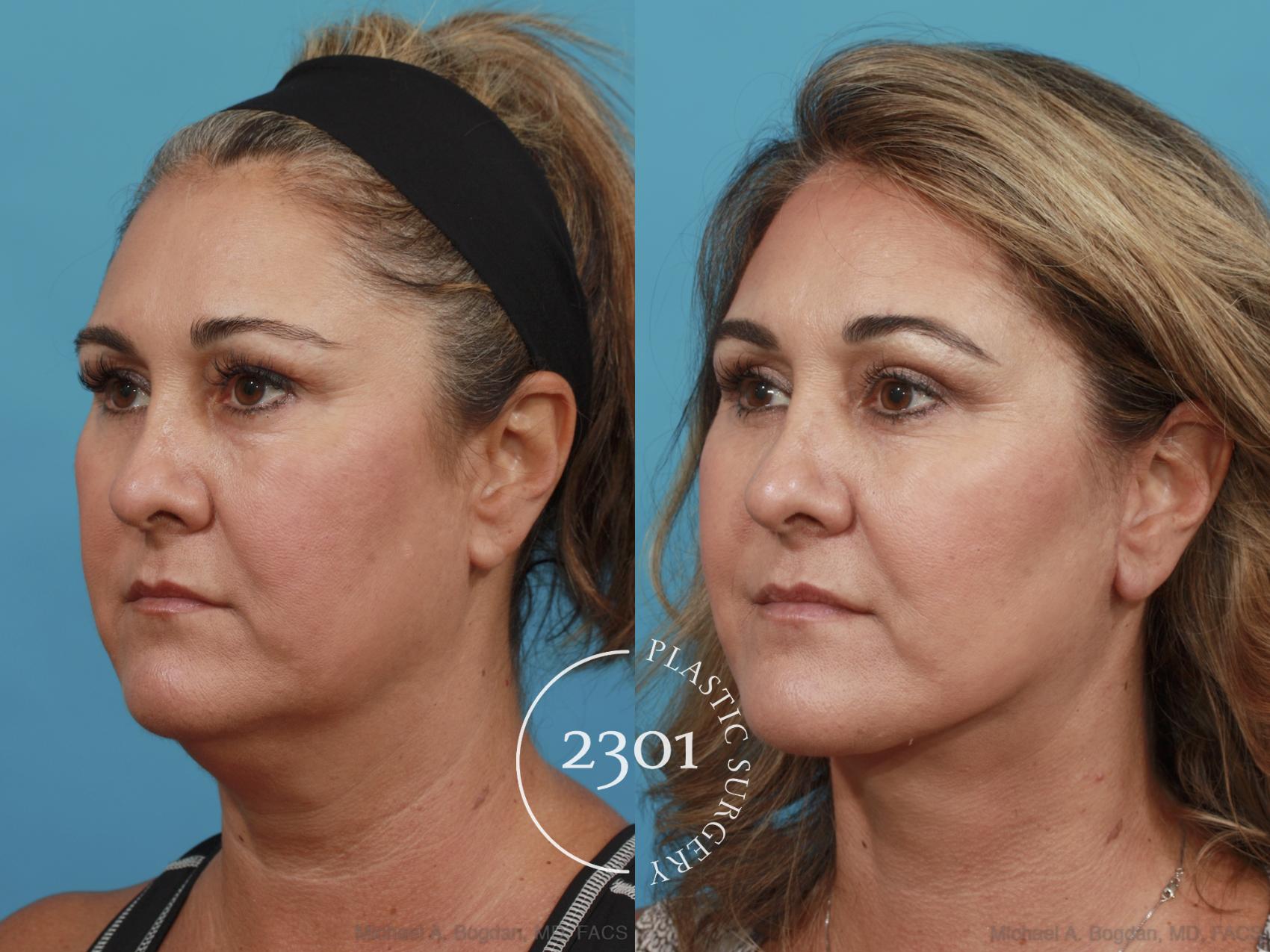 Before & After Neck Lift Case 503 View #2 View in Fort Worth, Plano, & Frisco, Texas