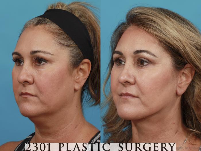Before & After Neck Lift Case 503 View #2 View in Fort Worth, Plano, & Frisco, Texas