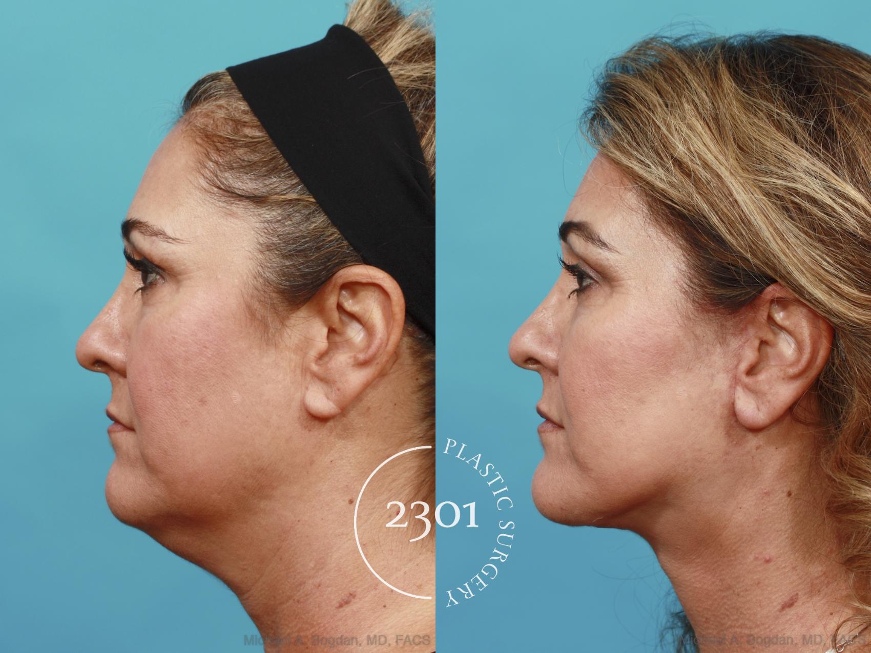 Before & After Neck Lift Case 503 View #3 View in Fort Worth, Plano, & Frisco, Texas