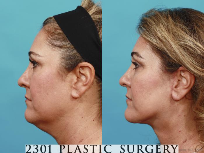 Before & After Neck Lift Case 503 View #3 View in Fort Worth, Plano, & Frisco, Texas