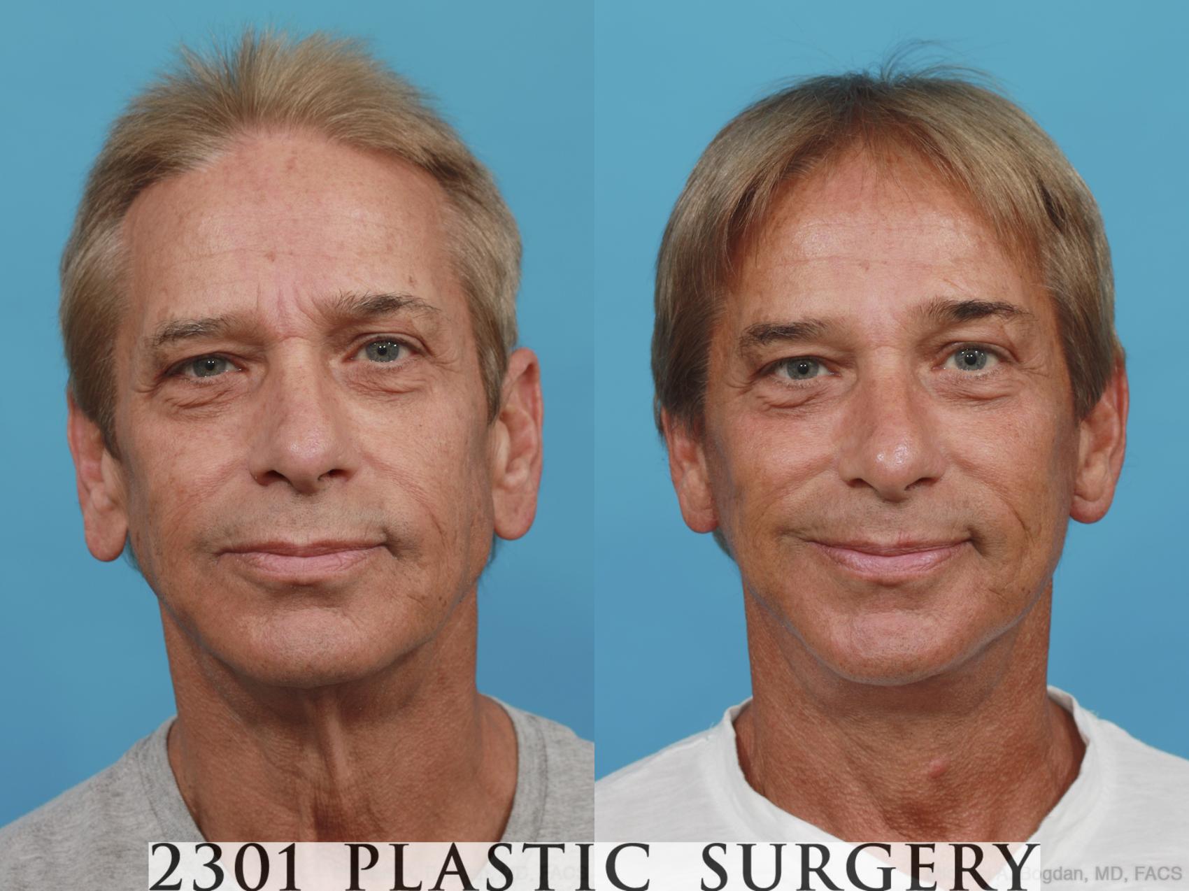 Before & After Face Lift Case 504 View #1 View in Fort Worth & Frisco, Texas