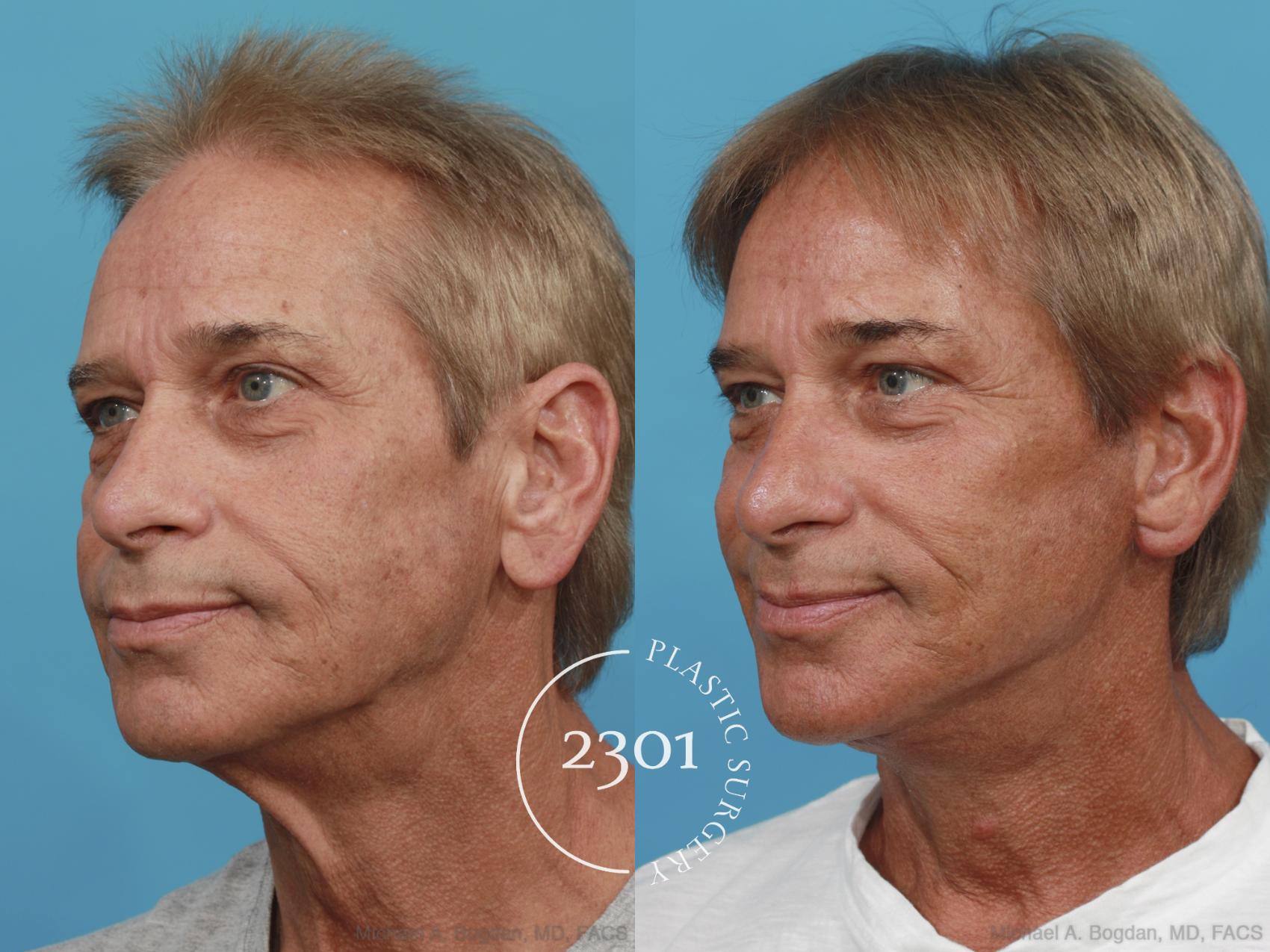 Before & After Male Face Lift Case 504 View #2 View in Fort Worth, Plano, & Frisco, Texas