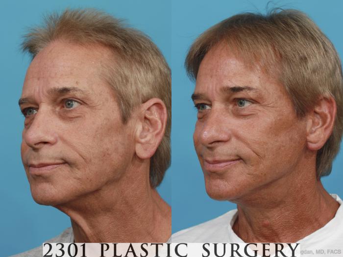 Before & After Neck Lift Case 504 View #2 View in Fort Worth, Plano, & Frisco, Texas