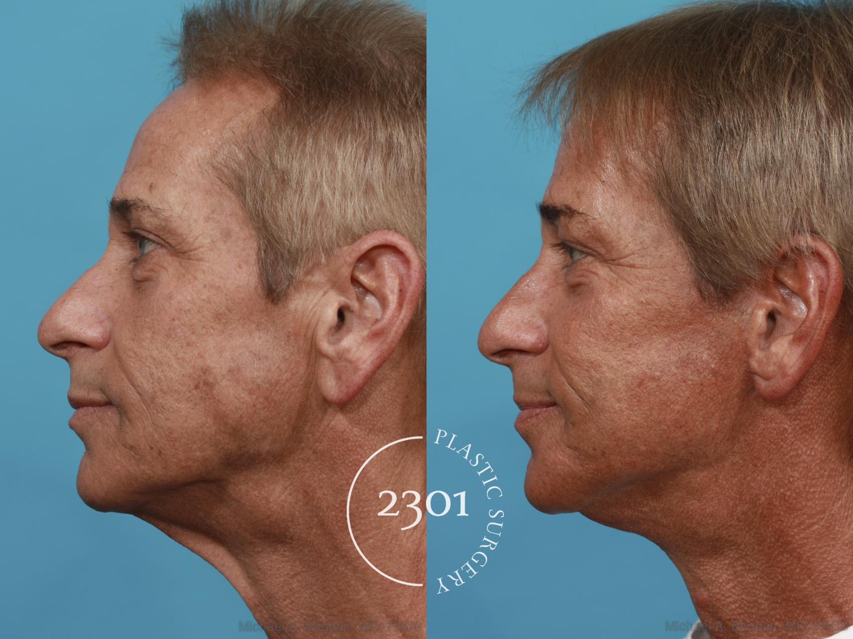 Before & After Male Face Lift Case 504 View #3 View in Fort Worth, Plano, & Frisco, Texas