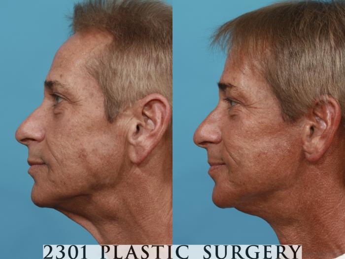 Before & After Neck Lift Case 504 View #3 View in Fort Worth, Plano, & Frisco, Texas