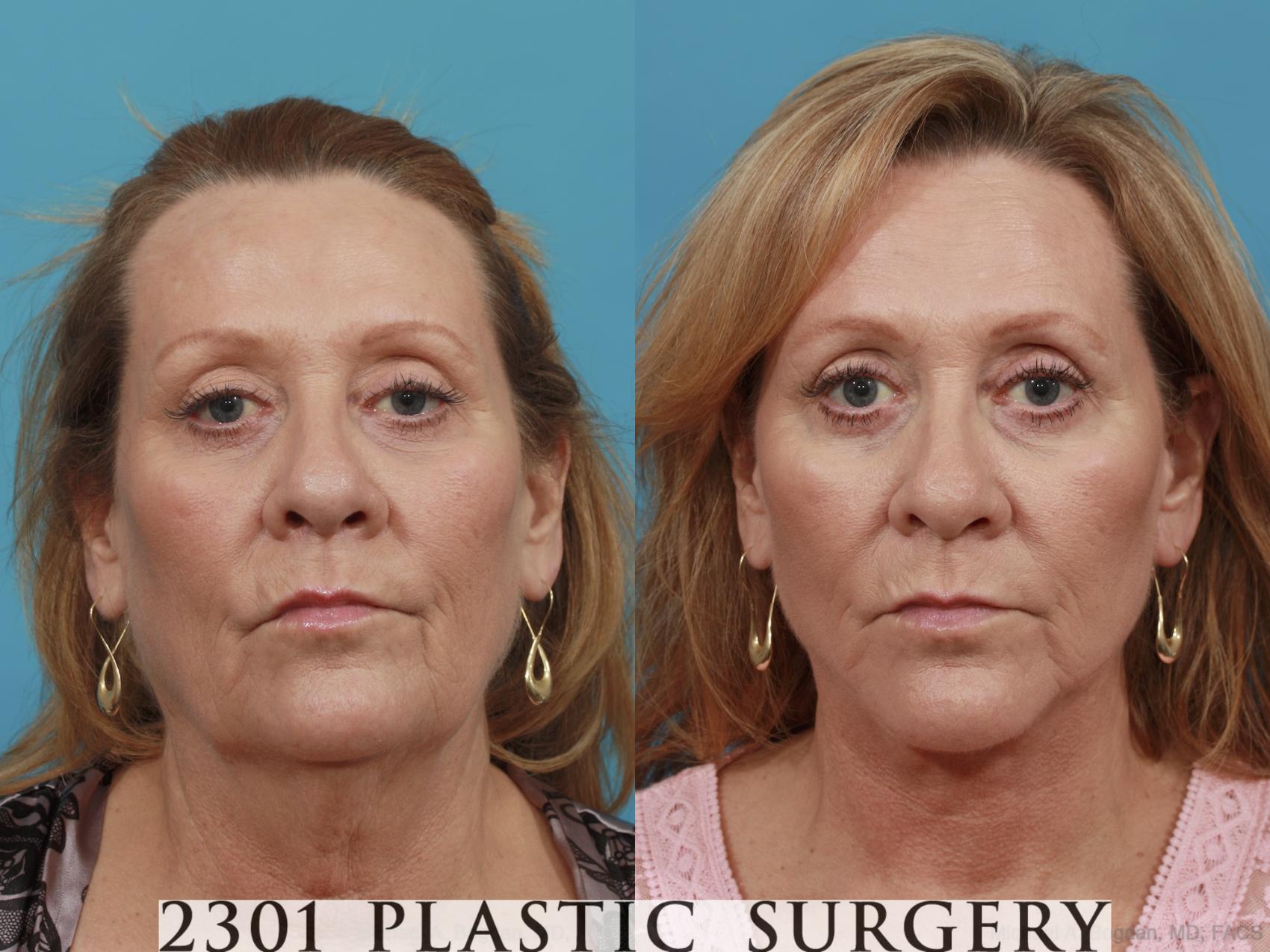 Before & After Neck Lift Case 510 View #1 View in Fort Worth, Plano, & Frisco, Texas