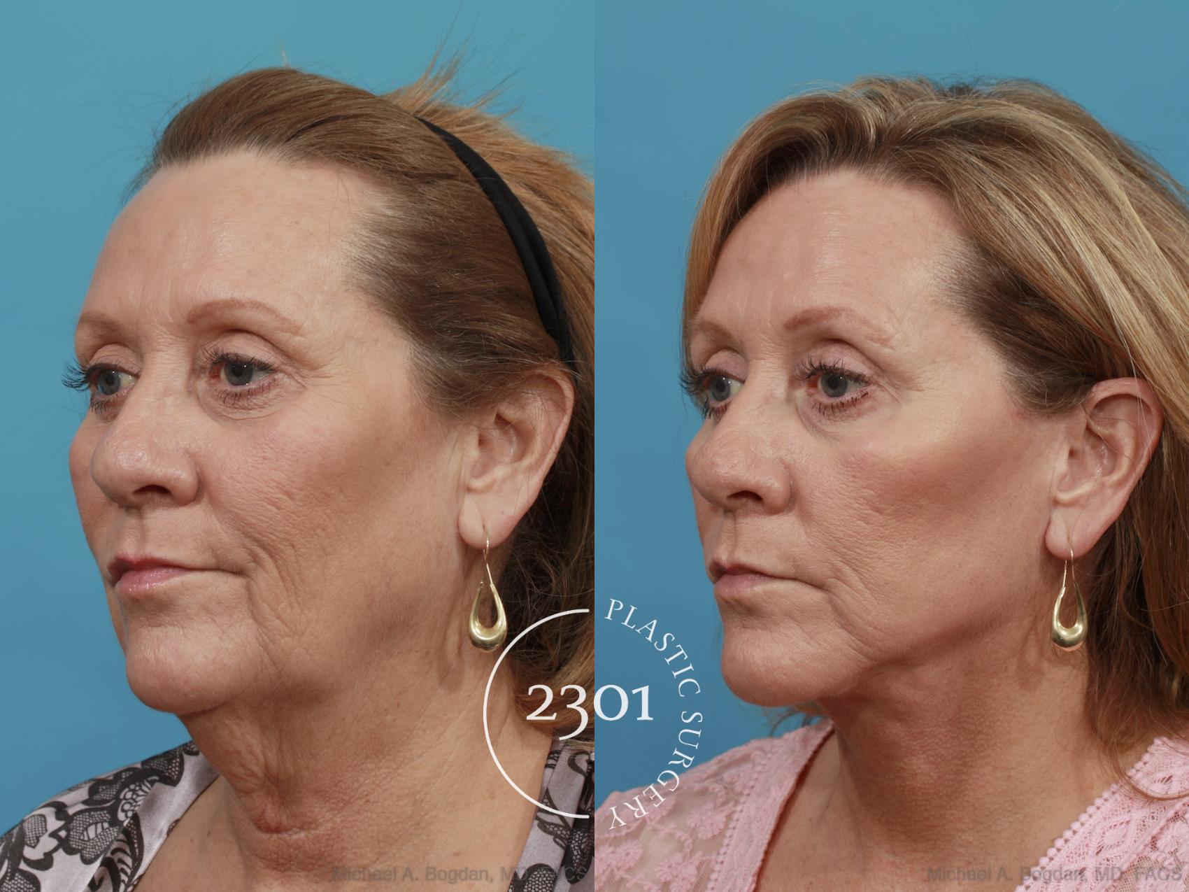 Before & After Face Lift Case 510 View #2 View in Fort Worth, Plano, & Frisco, Texas