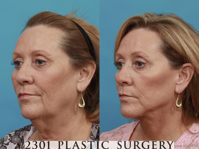 Before & After Face Lift Case 510 View #2 View in Fort Worth, Plano, & Frisco, Texas