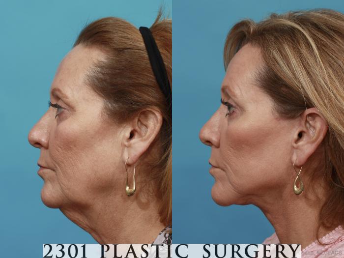 Before & After Neck Lift Case 510 View #3 View in Fort Worth, Plano, & Frisco, Texas