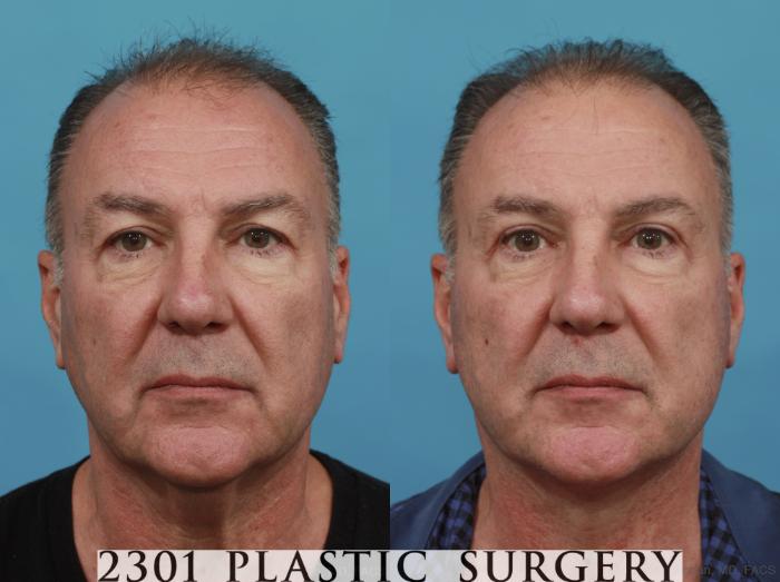 Before & After Male Face Lift Case 523 View #1 View in Fort Worth & Frisco, Texas