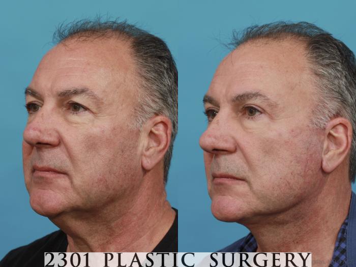Before & After Male Eyelid Surgery Case 523 View #2 View in Fort Worth, Plano, & Frisco, Texas