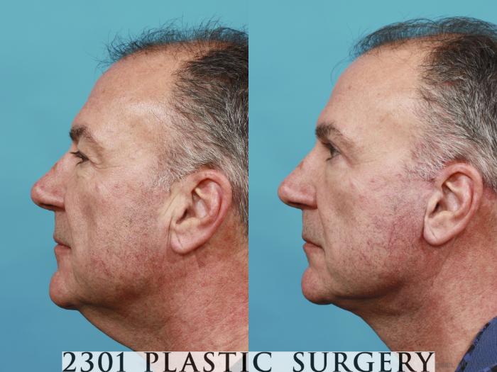 Before & After Neck Lift Case 523 View #3 View in Fort Worth, Plano, & Frisco, Texas