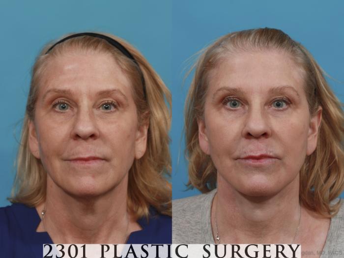 Before & After Face Lift Case 526 View #1 View in Fort Worth, Plano, & Frisco, Texas