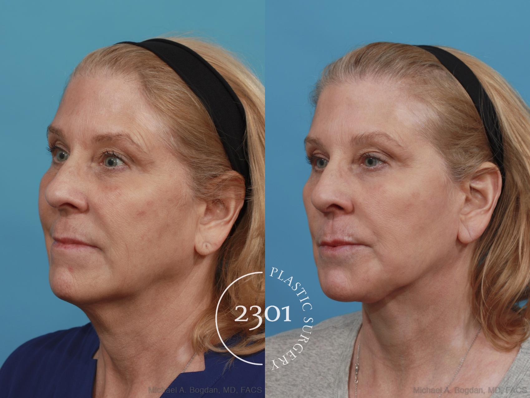 Before & After Face Lift Case 526 View #2 View in Fort Worth, Plano, & Frisco, Texas