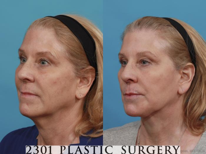 Before & After Face Lift Case 526 View #2 View in Fort Worth, Plano, & Frisco, Texas