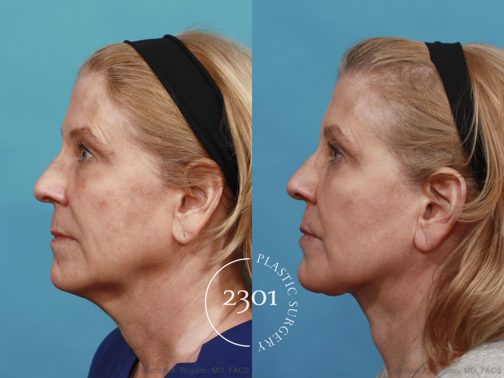 Before & After Face Lift Case 526 View #3 View in Fort Worth, Plano, & Frisco, Texas