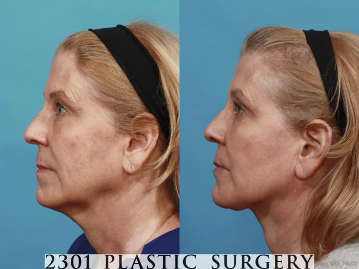 Before & After Neck Lift Case 526 View #3 View in Fort Worth, Plano, & Frisco, Texas