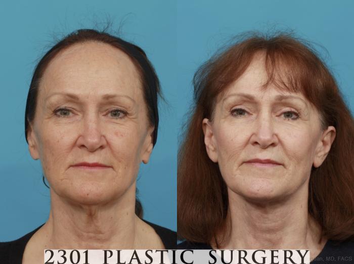 Before & After Face Lift Case 541 View #1 View in Fort Worth, Plano, & Frisco, Texas