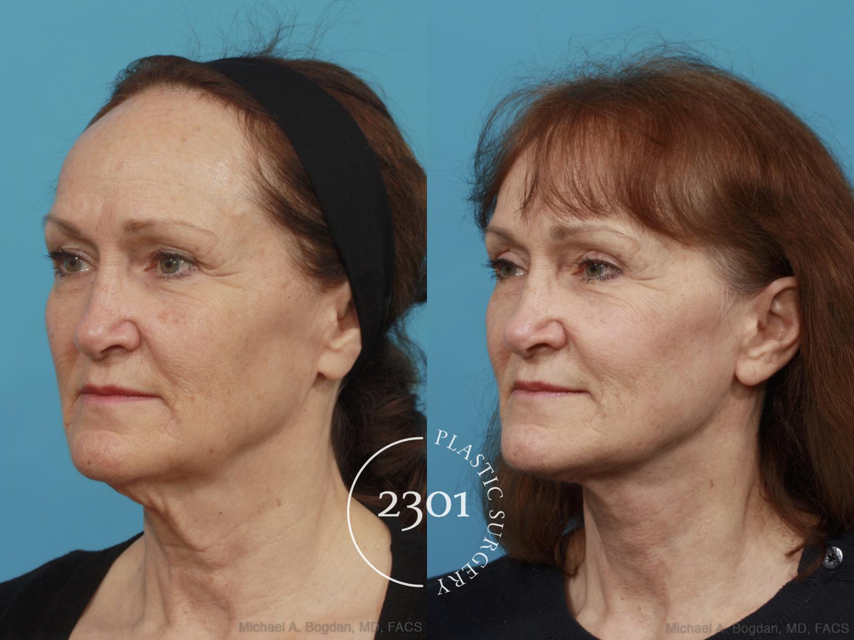 Before & After Face Lift Case 541 View #2 View in Fort Worth, Plano, & Frisco, Texas