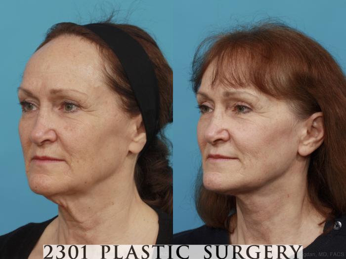 Before & After Neck Lift Case 541 View #2 View in Fort Worth, Plano, & Frisco, Texas