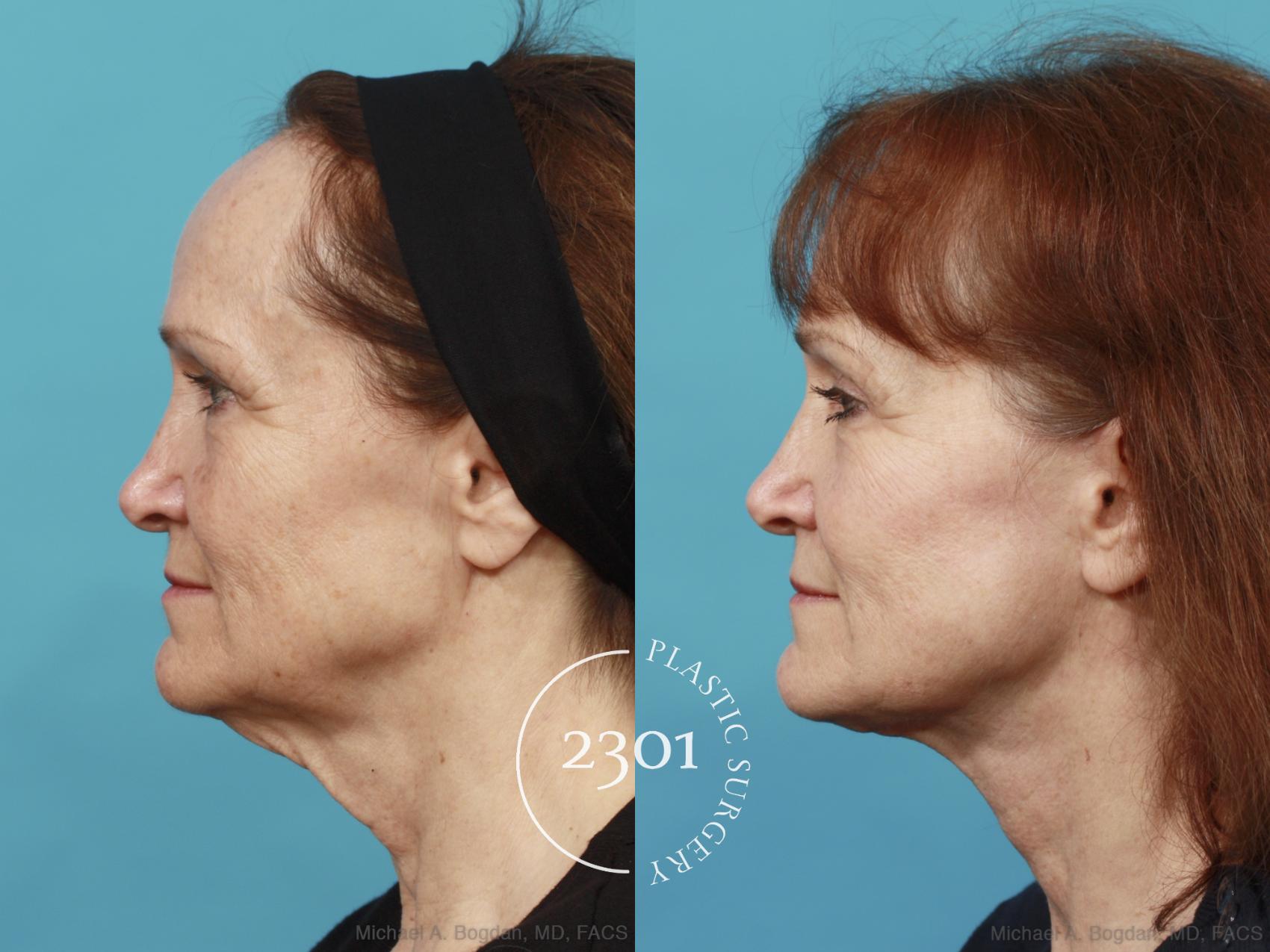 Before & After Face Lift Case 541 View #3 View in Fort Worth, Plano, & Frisco, Texas
