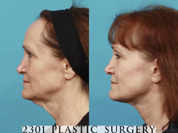 Before & After Face Lift Case 541 View #3 View in Fort Worth, Plano, & Frisco, Texas