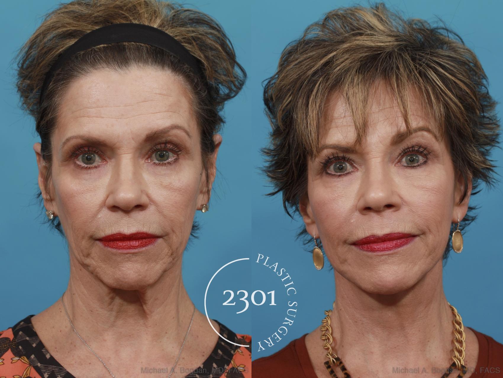 Before & After Neck Lift Case 550 View #1 View in Fort Worth, Plano, & Frisco, Texas