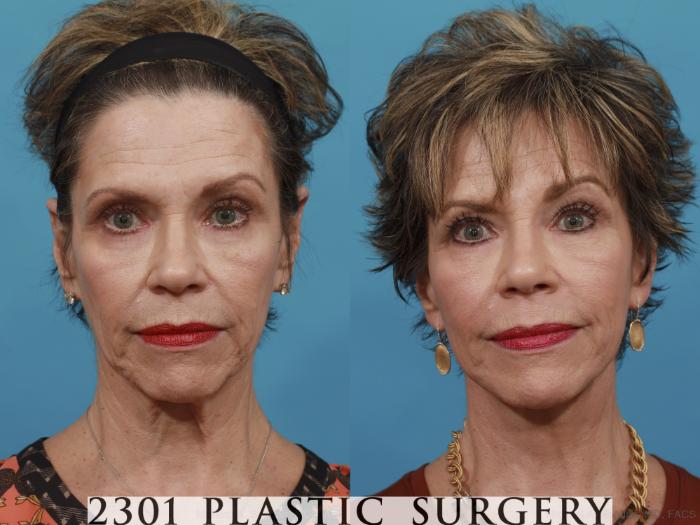 Before & After Neck Lift Case 550 View #1 View in Fort Worth & Frisco, Texas