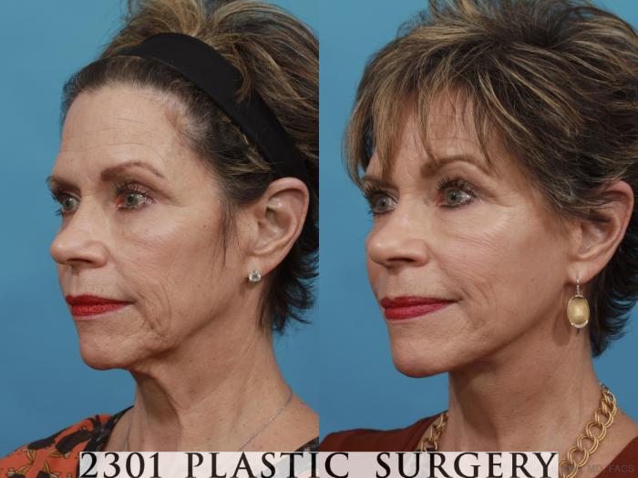 Before & After Neck Lift Case 550 View #2 View in Fort Worth, Plano, & Frisco, Texas