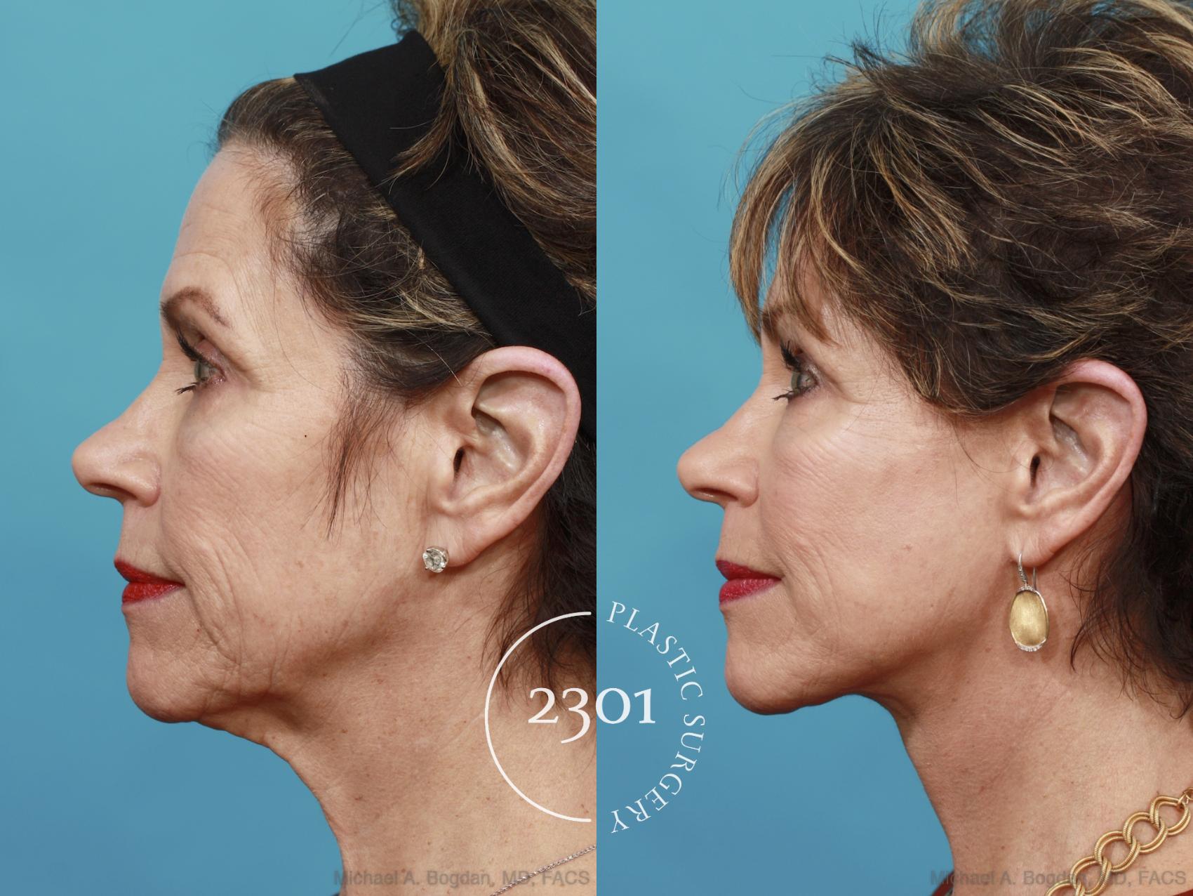 Before & After Neck Lift Case 550 View #3 View in Fort Worth, Plano, & Frisco, Texas