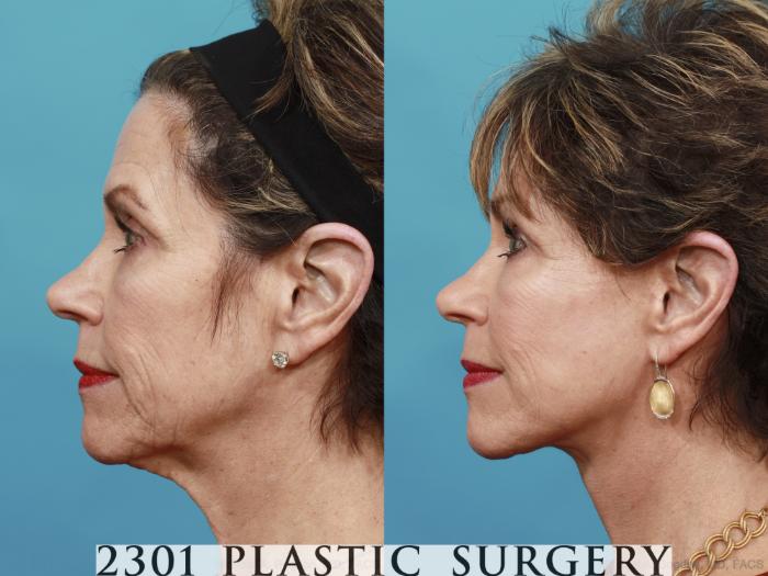 Before & After Neck Lift Case 550 View #3 View in Fort Worth, Plano, & Frisco, Texas