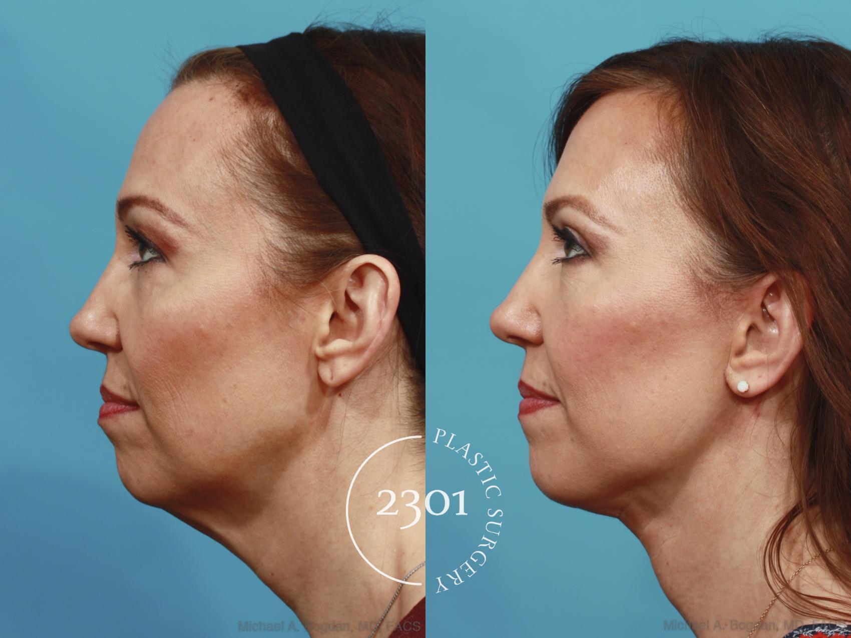 Before & After Neck Lift Case 577 View #2 View in Fort Worth, Plano, & Frisco, Texas