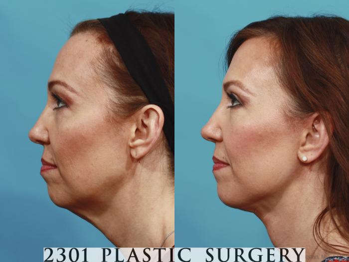 Before & After Face Lift Case 577 View #2 View in Fort Worth, Plano, & Frisco, Texas