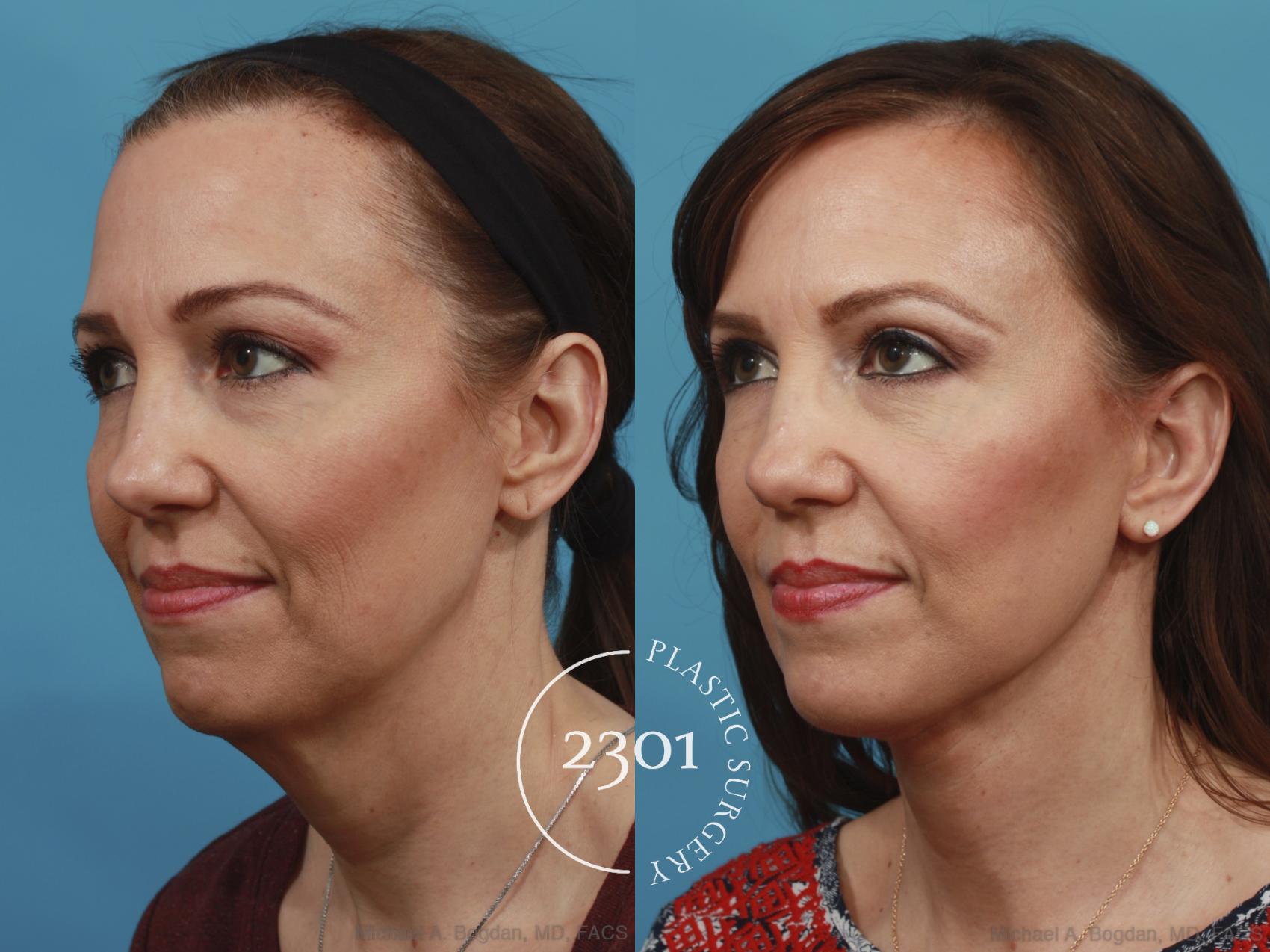 Before & After Neck Lift Case 577 View #3 View in Fort Worth, Plano, & Frisco, Texas