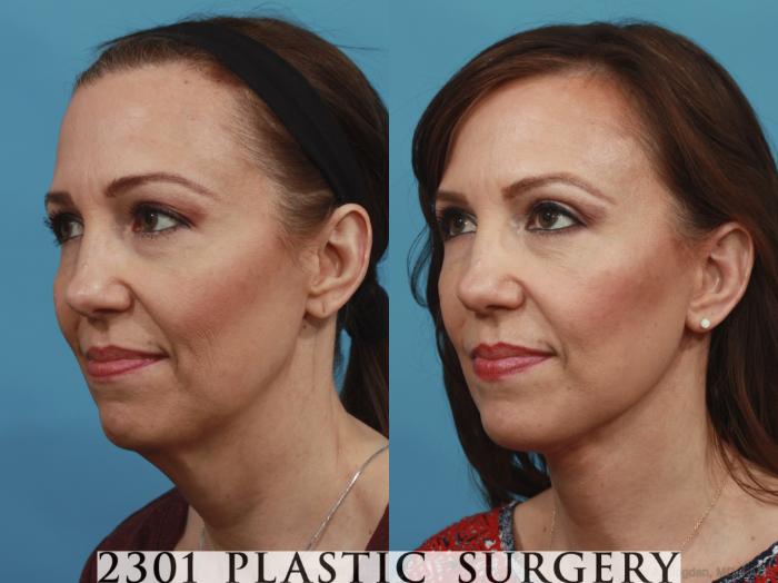 Before & After Face Lift Case 577 View #3 View in Fort Worth, Plano, & Frisco, Texas