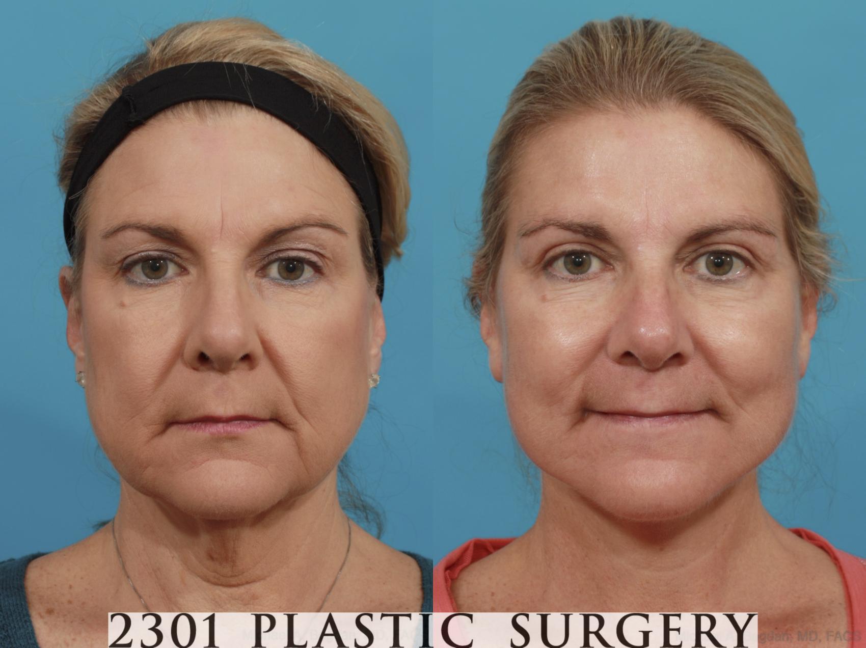 Before & After Face Lift Case 578 View #1 View in Fort Worth & Frisco, Texas