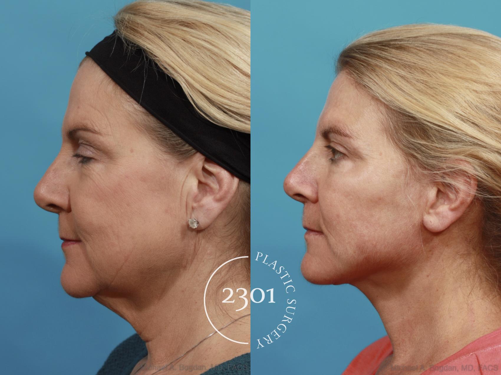 Before & After Face Lift Case 578 View #2 View in Fort Worth, Plano, & Frisco, Texas