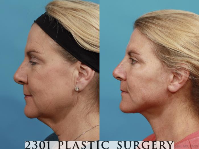 Before & After Face Lift Case 578 View #2 View in Fort Worth, Plano, & Frisco, Texas