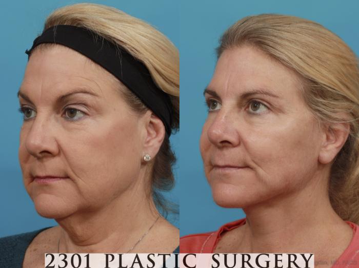 Before & After Face Lift Case 578 View #3 View in Fort Worth, Plano, & Frisco, Texas