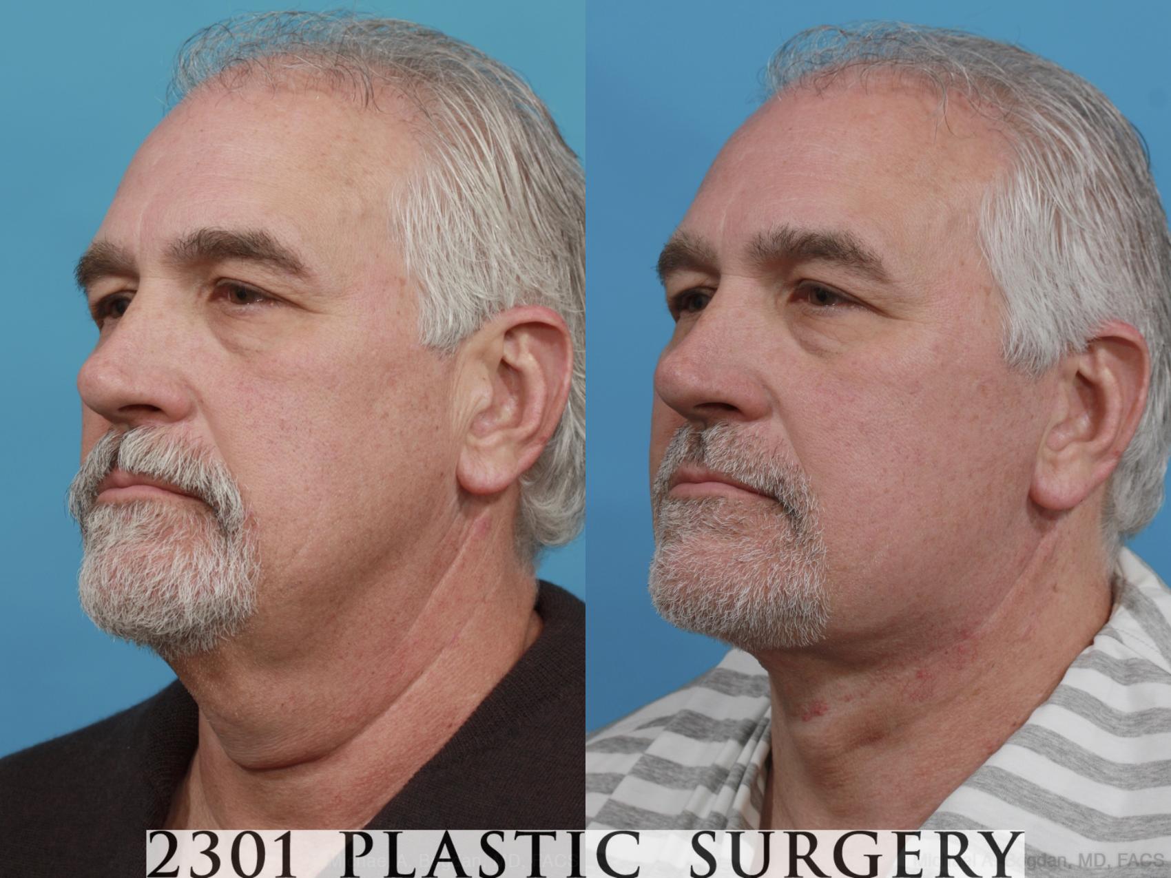 Before & After Neck Lift Case 581 View #2 View in Fort Worth & Frisco, Texas