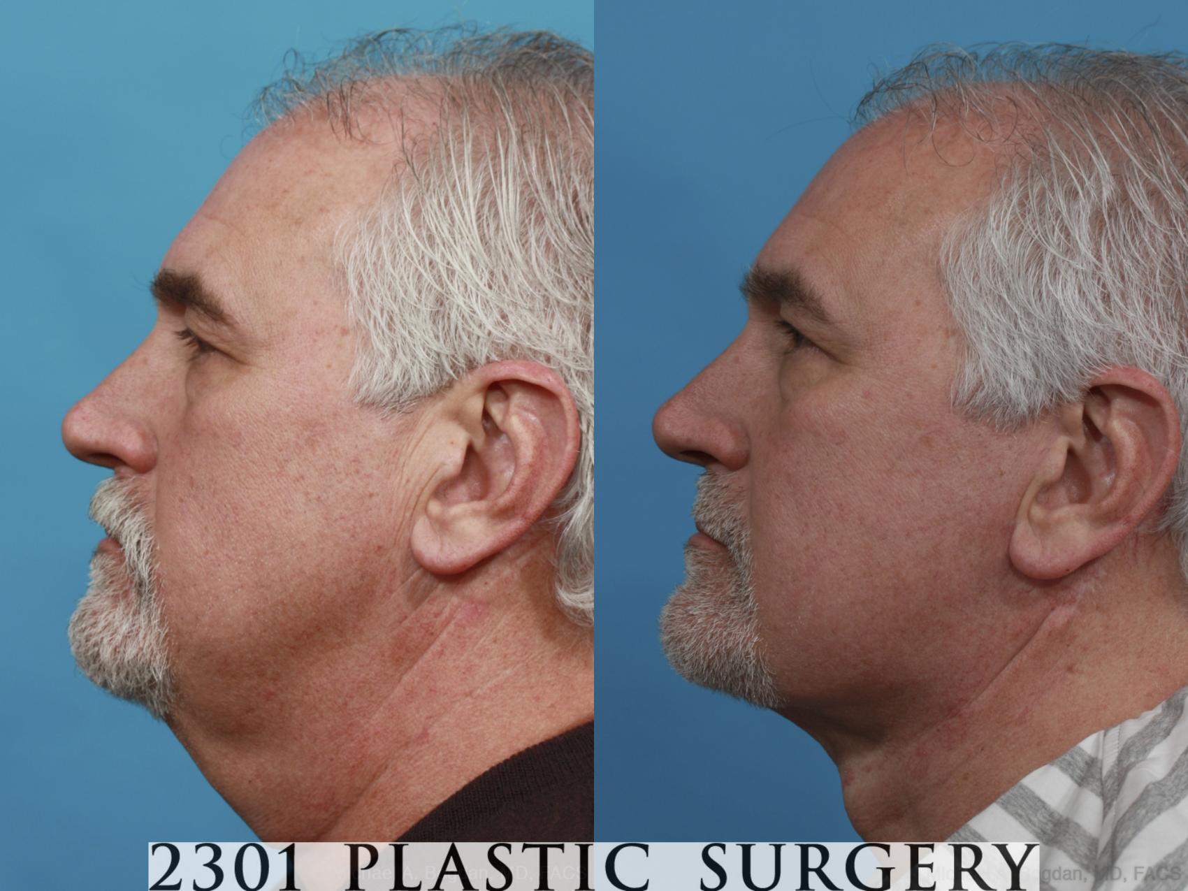 Before & After Neck Lift Case 581 View #3 View in Fort Worth & Frisco, Texas